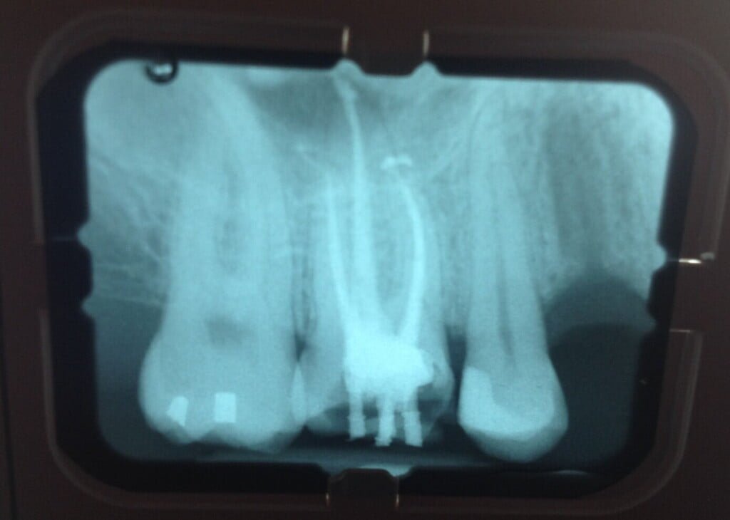 Mason Dentistry - Root Canals