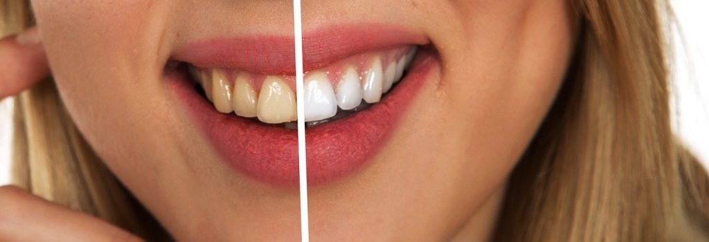 Mason Dentistry - How to Whiten teeth