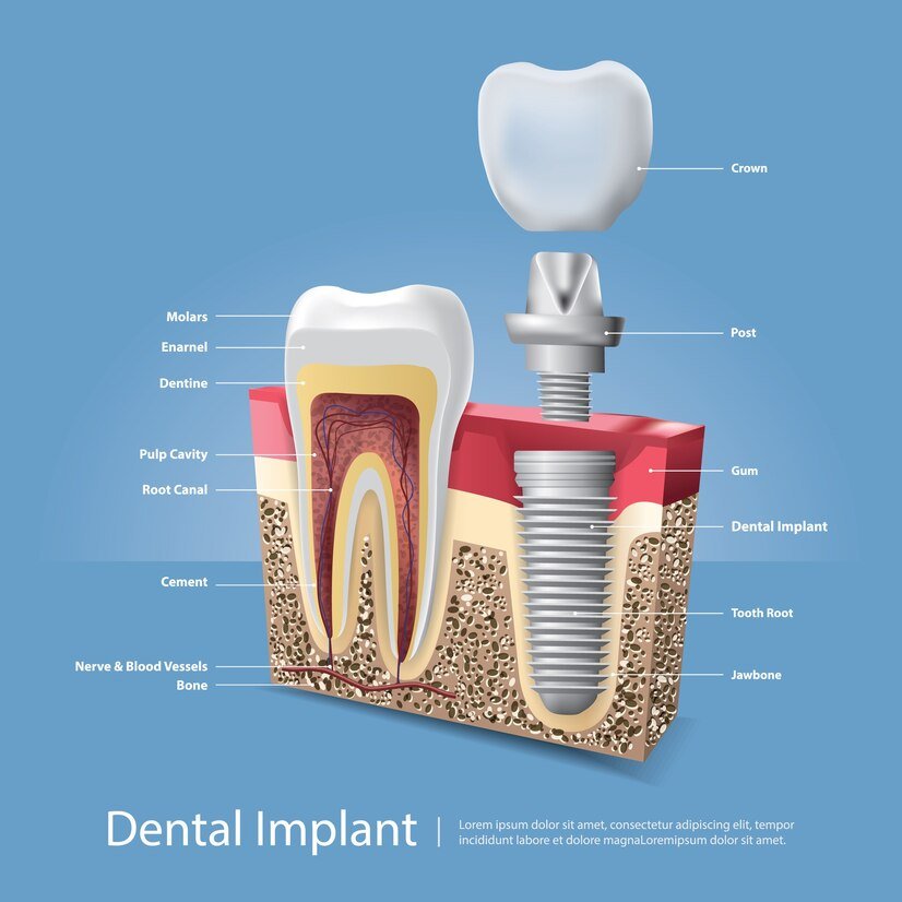 Implant Mason Dentistry New Home